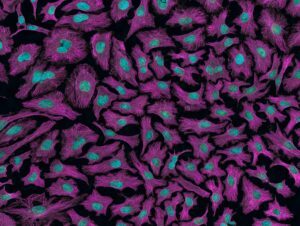 Cancerceller sedda genom mikrosokop